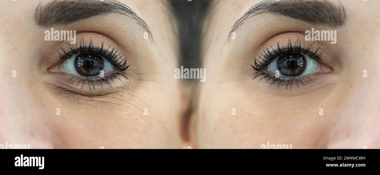 the effects of before and after rejuvenating treatment in woman face. Puffiness, dark circles unde eye, eye bags and crow's feet removal Stock Photo