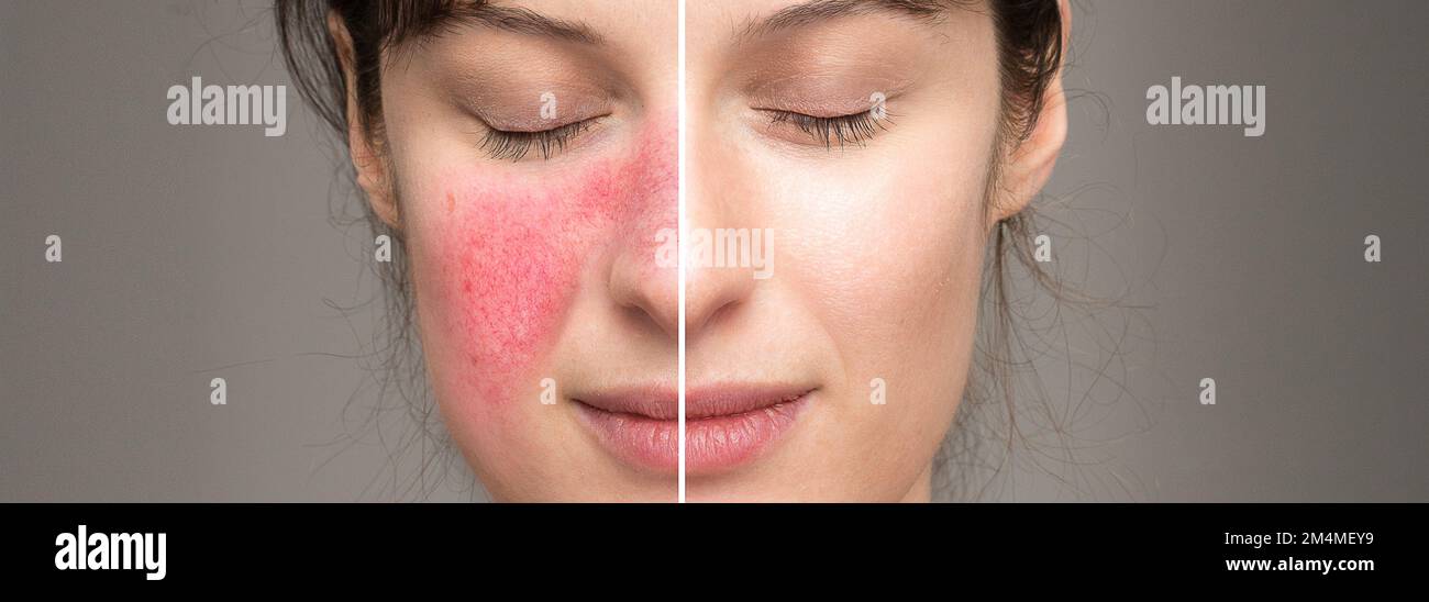 signs and symptoms of rosacea: natural cures in the treatment of skin disorders. Couperose before and after laser treatment Stock Photo