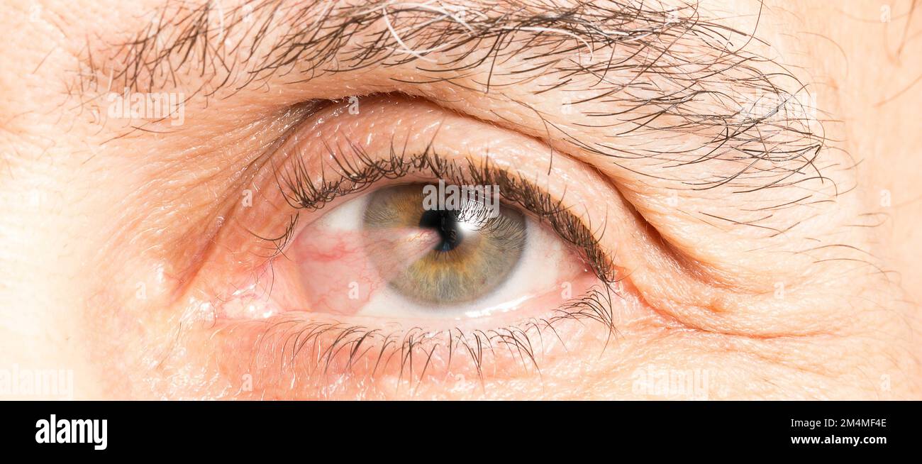 Macro of a senior's eye affected by pterygium, a wing-like triangular membrane occurring in the eyes that reduces the vision in several ways Stock Photo