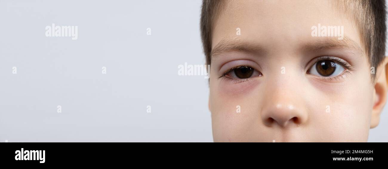 Eye of a child with conjunctivitis, inflammation of the conjunctiva, close-up. Stock Photo