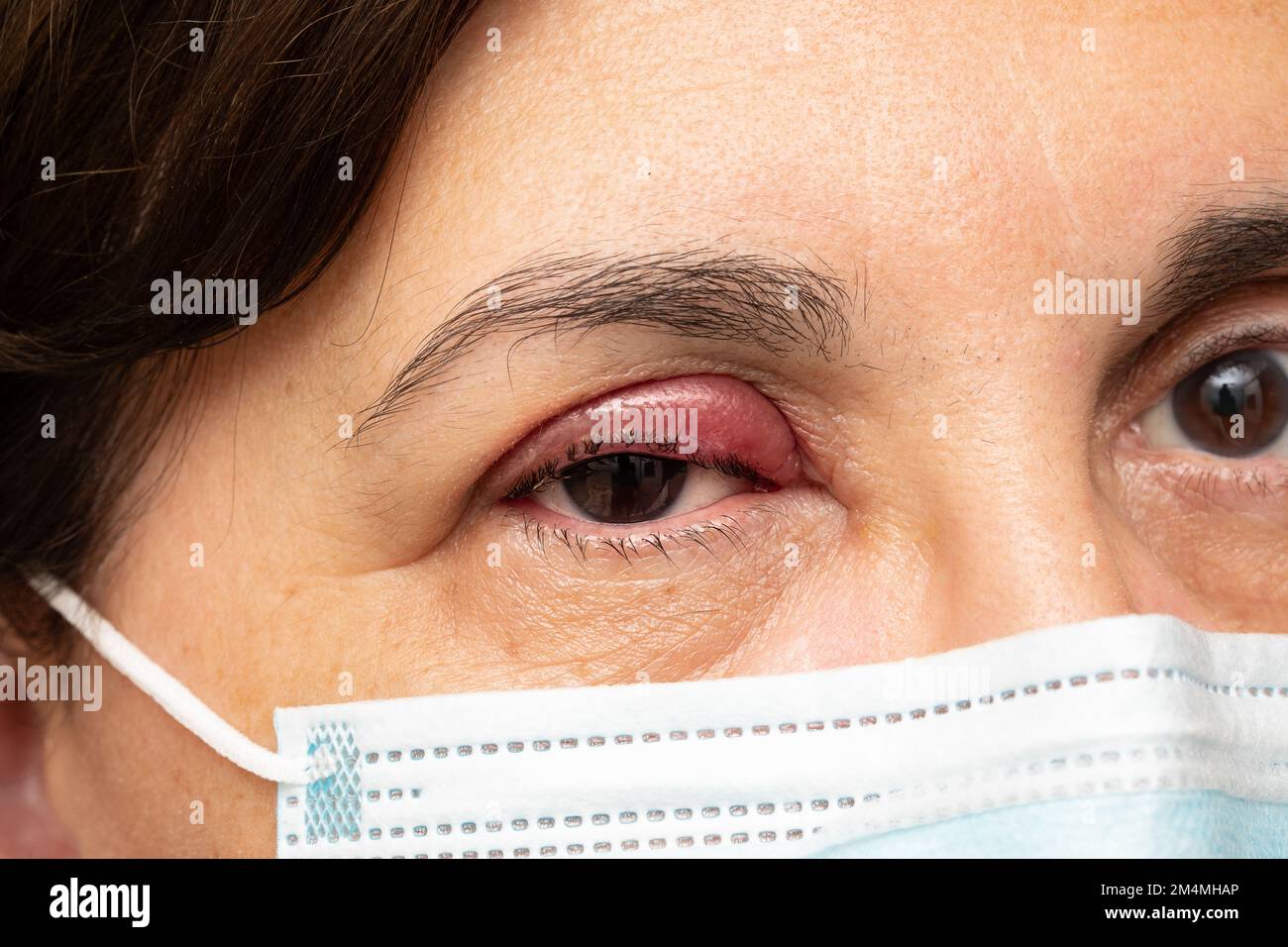 Close up woman left brown eye suppurated look straight to camera .Painful red fester eyelash woman in 60s Stock Photo