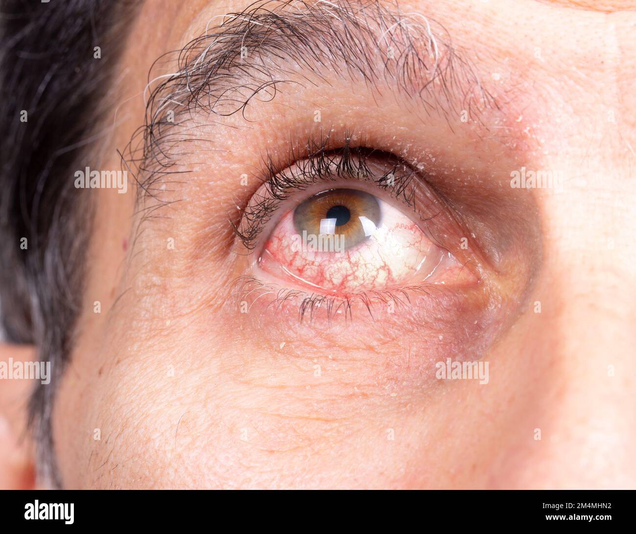 Macro of the eye of a caucasian man suffering from uveitis. Eye with redness due to red capillaries. Uveitis causes irritation and tearing of the eyes Stock Photo