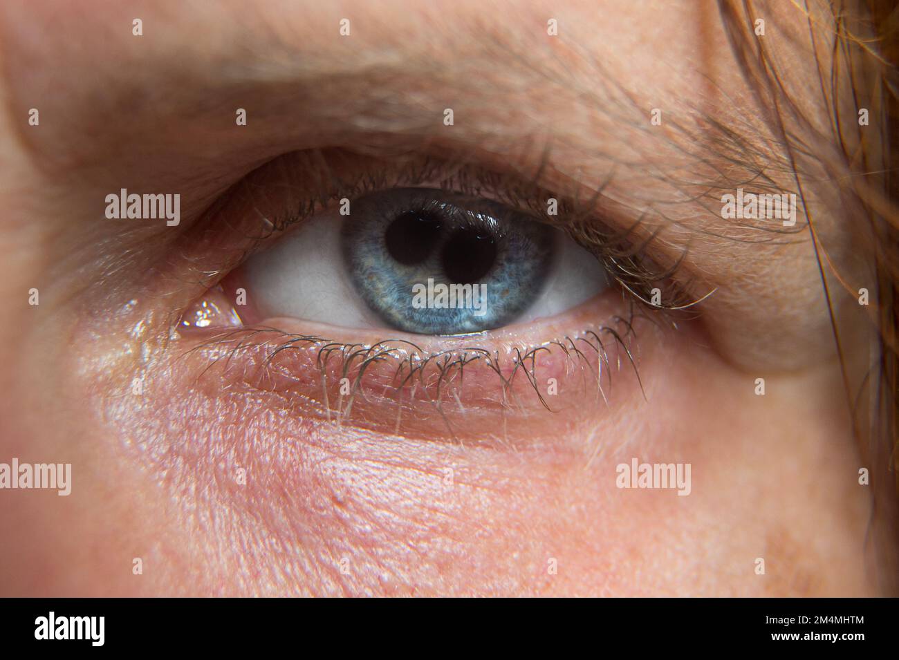 Macro of a woman's blue eye with polycoria, doubling of the pupil. Rare case of eye with two pupils Stock Photo