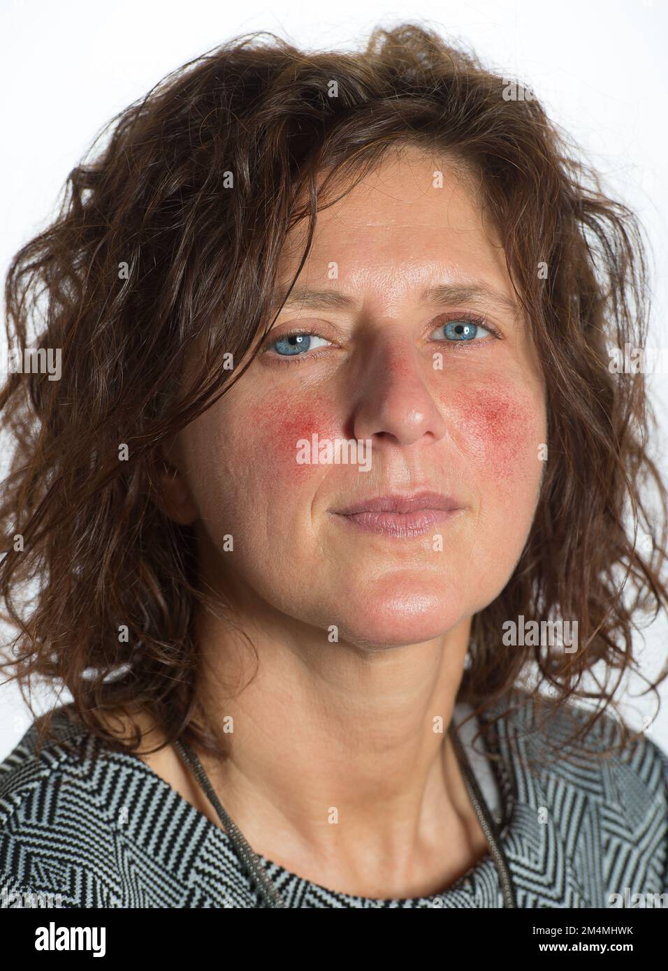 Young lady with red cheeks due to dilation of the capillaries due to rosacea, also called couperose. Dermatological problem that causes skin problems Stock Photo