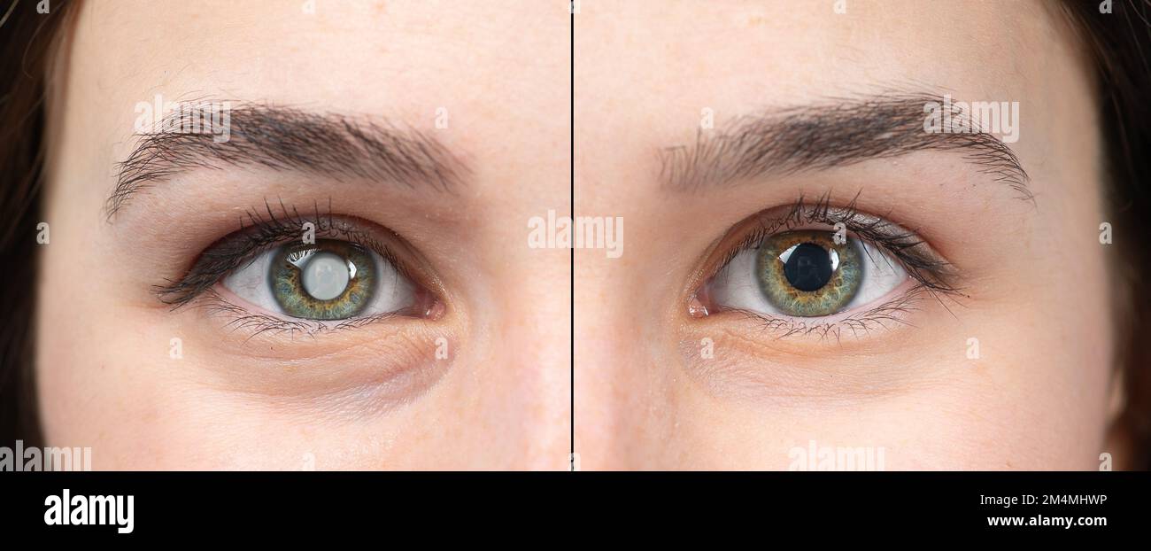 Macro of the eye of a young woman with and without cataracts. Simulation of before and after cataract removal surgery to avoid blindness Stock Photo