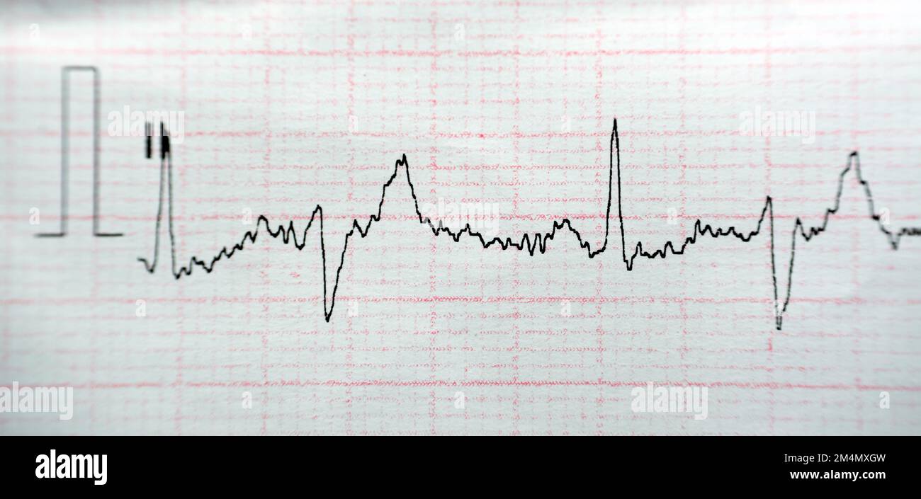 ECG ElectroCardioGraph paper that shows Normal Sinus Rhythm NSR with ...