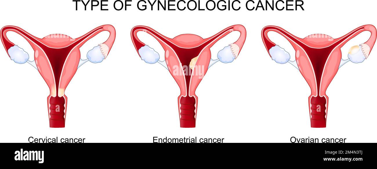 Type of gynecologic cancer. Ovarian, Endometrial, and Cervical cancer. diagram shows cross section of uterus with different parts of a woman Stock Vector