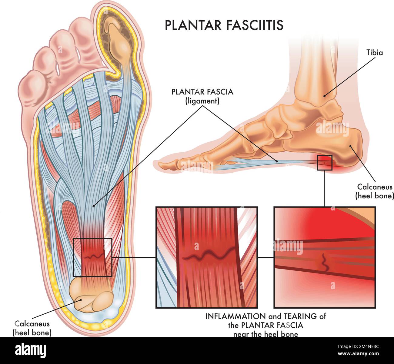 Medical illustration showing section of foot with symptoms of plantar fasciitis with two magnified details of affected points, and annotations. Stock Vector