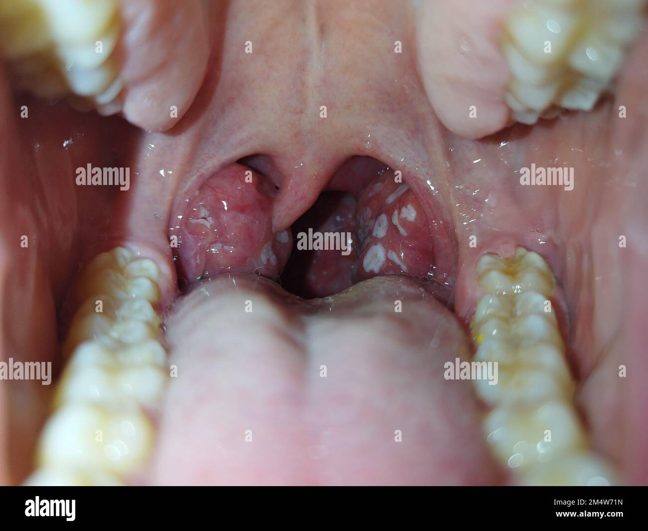 Tonsil Puss Draining tonsil-puss-draining