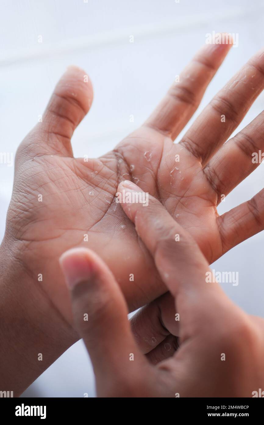 close up of Dry cracked skin of a men's hand  Stock Photo