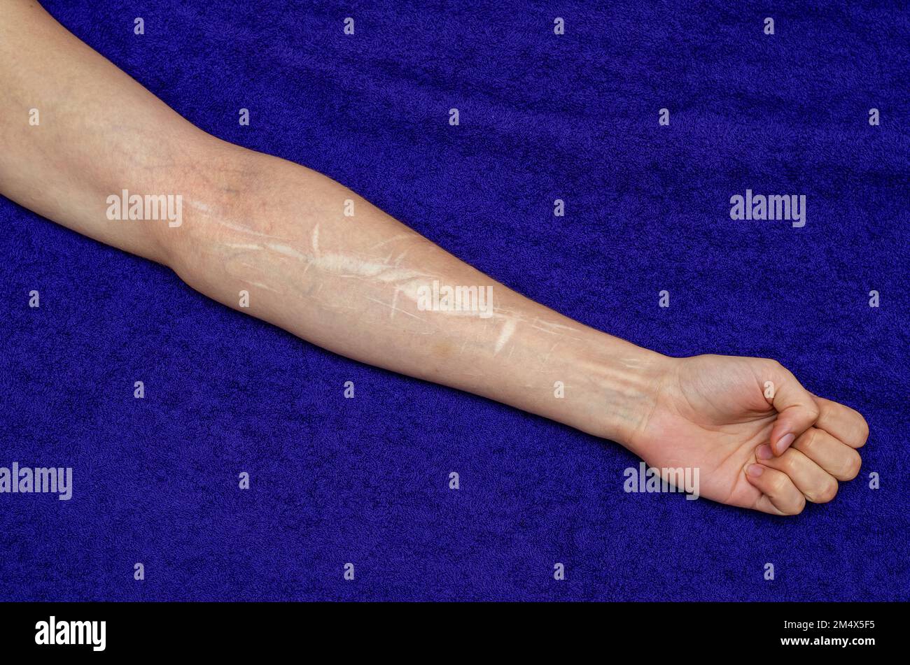 Arm Caucasian Woman Cutting Scars Stock Photo 1463057246