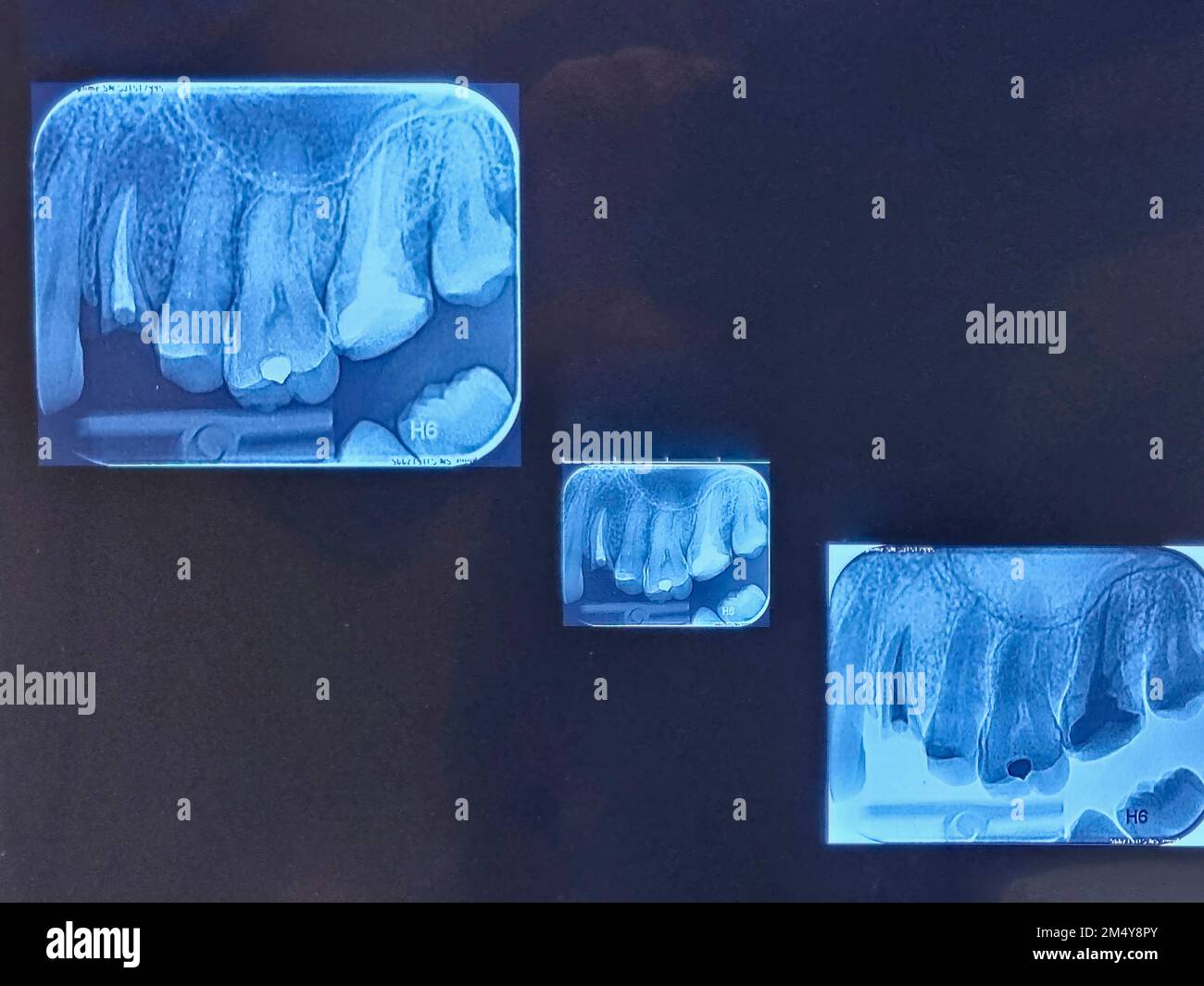 Dental x-ray image, teeth x-ray film. Stock Photo