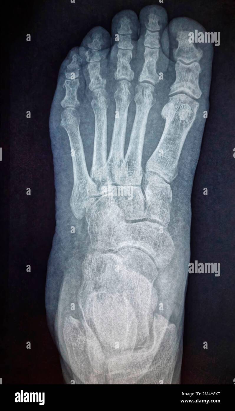 X-ray image of foot, radiography of food bones. Stock Photo
