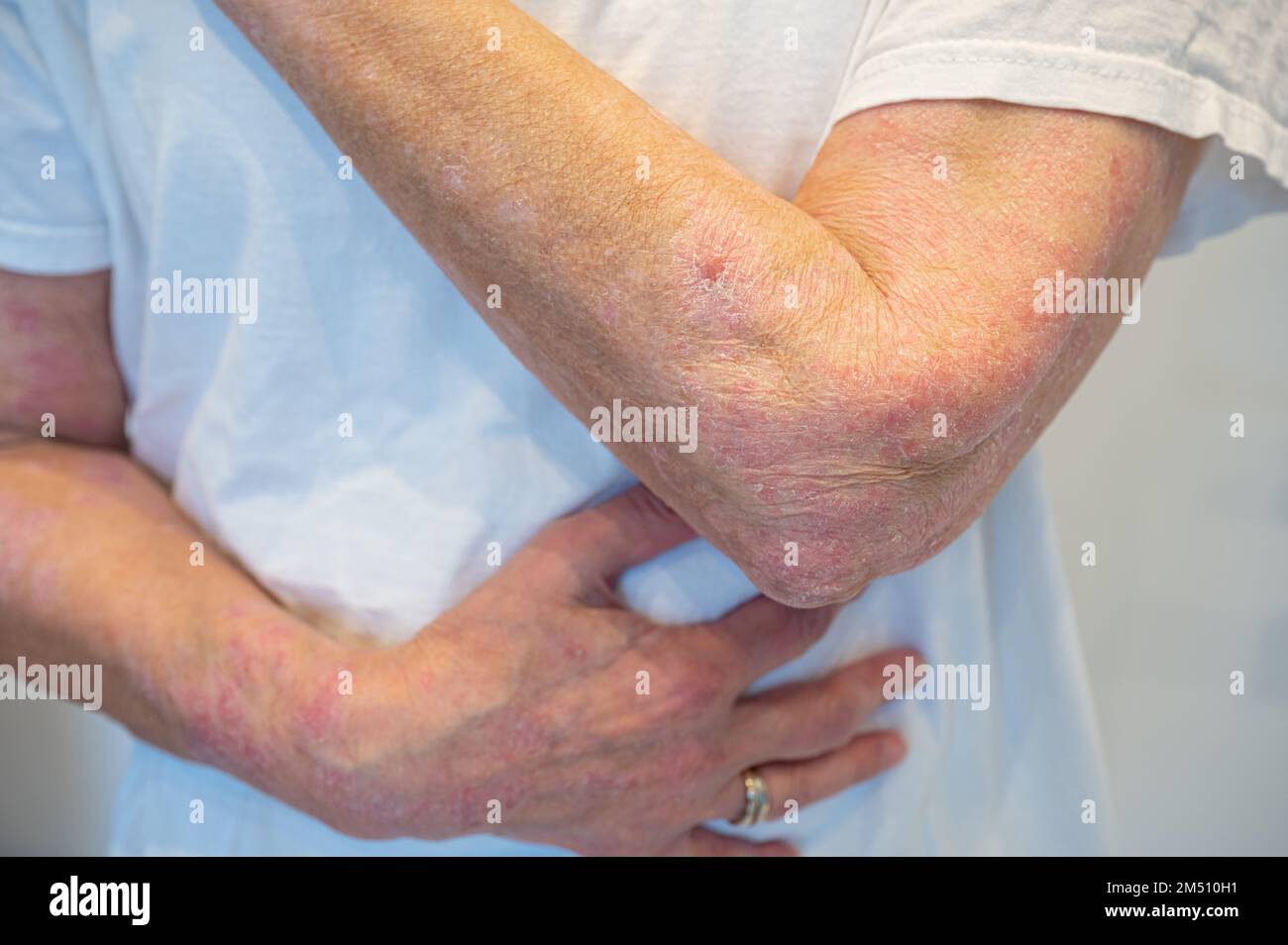 Skin disease psoriasis on arm and hand Stock Photo