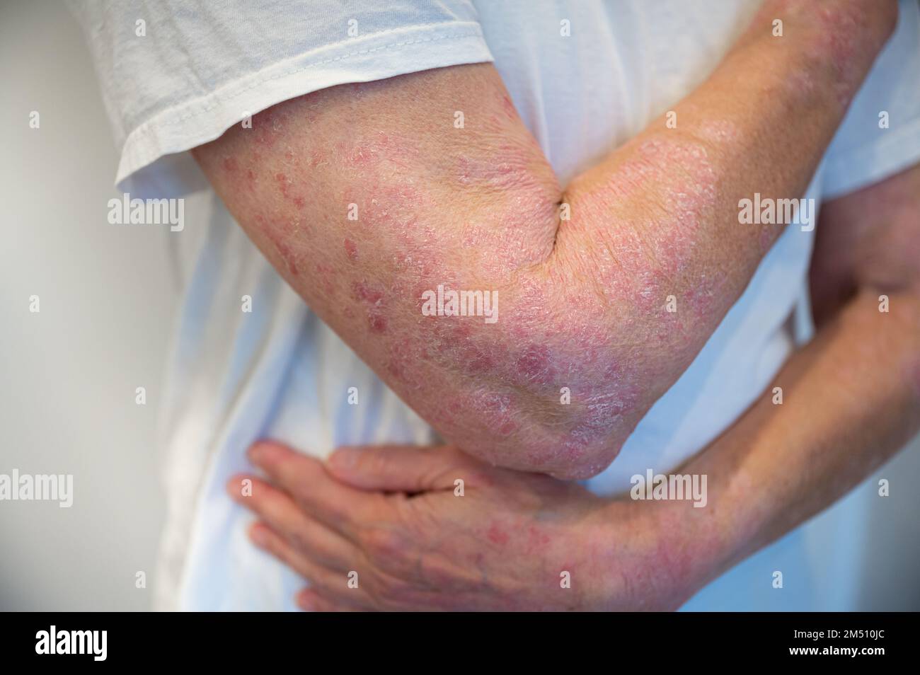 Skin disease psoriasis on arm and hand Stock Photo
