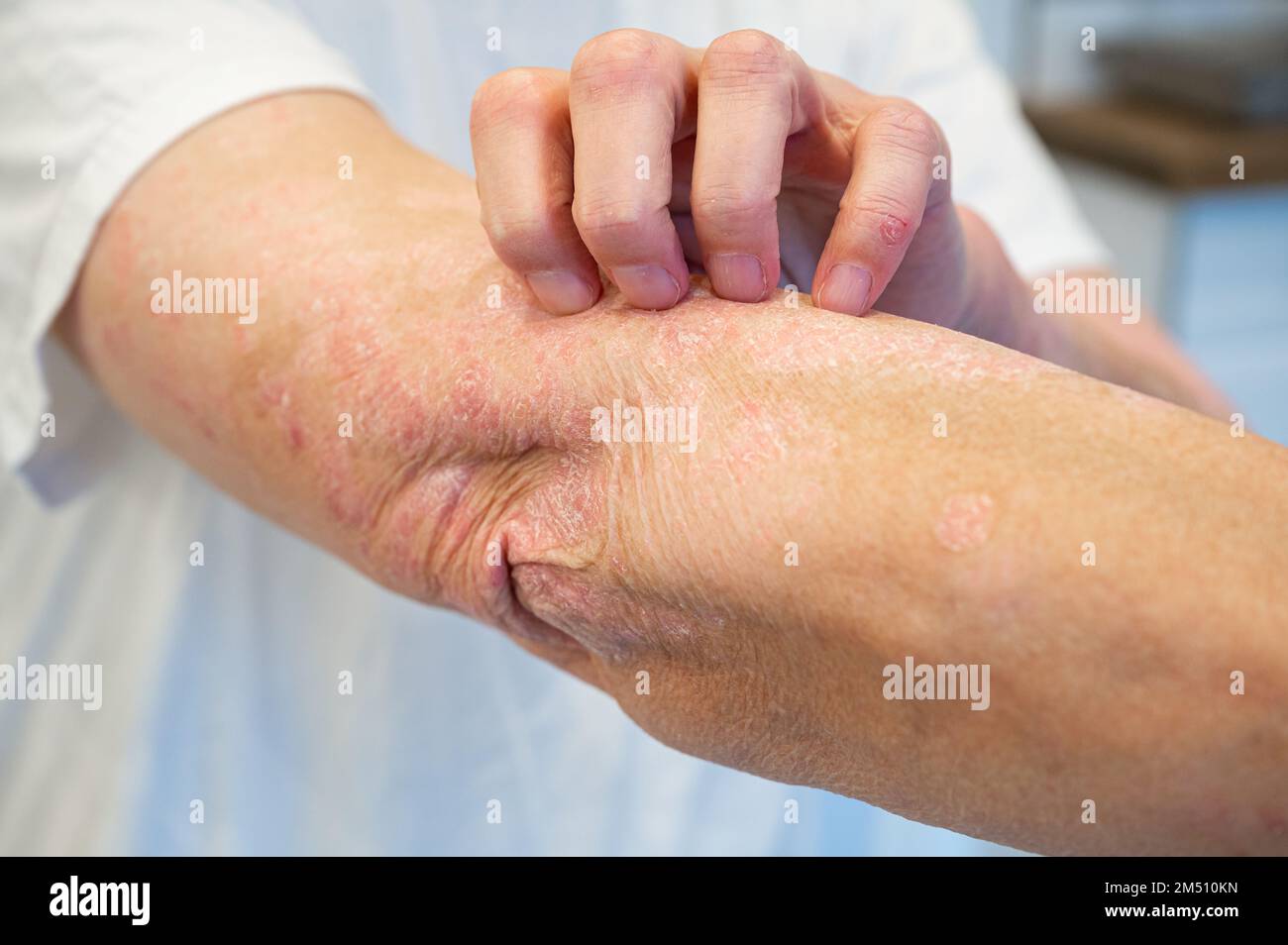 Itchy arm hi-res stock photography and images - Alamy