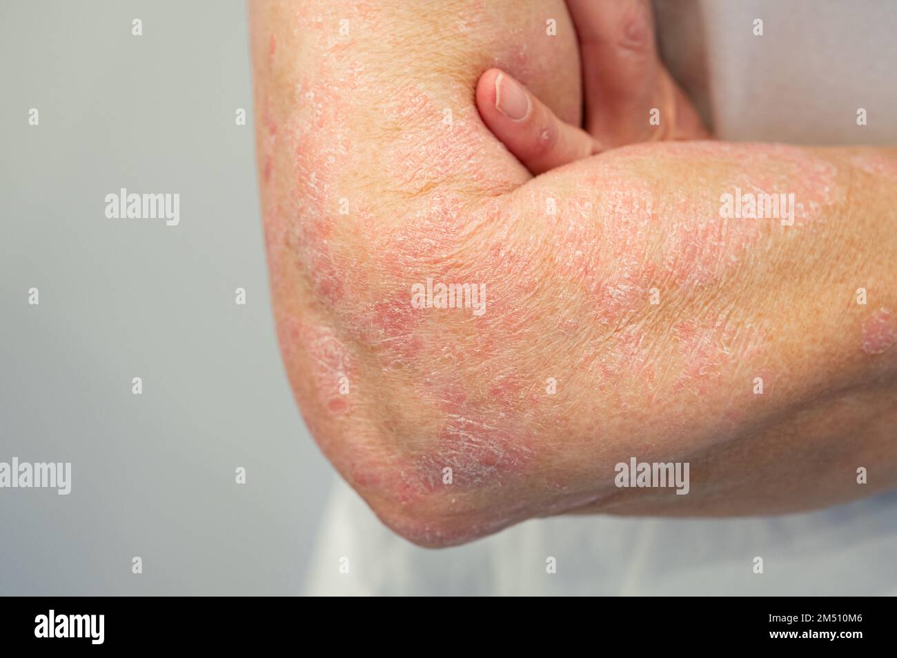 Itchy psoriasis on arm and hand Stock Photo - Alamy