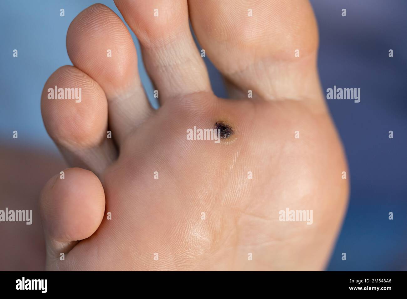Closeup of wart plantar after cauterizing it with celandine on infected