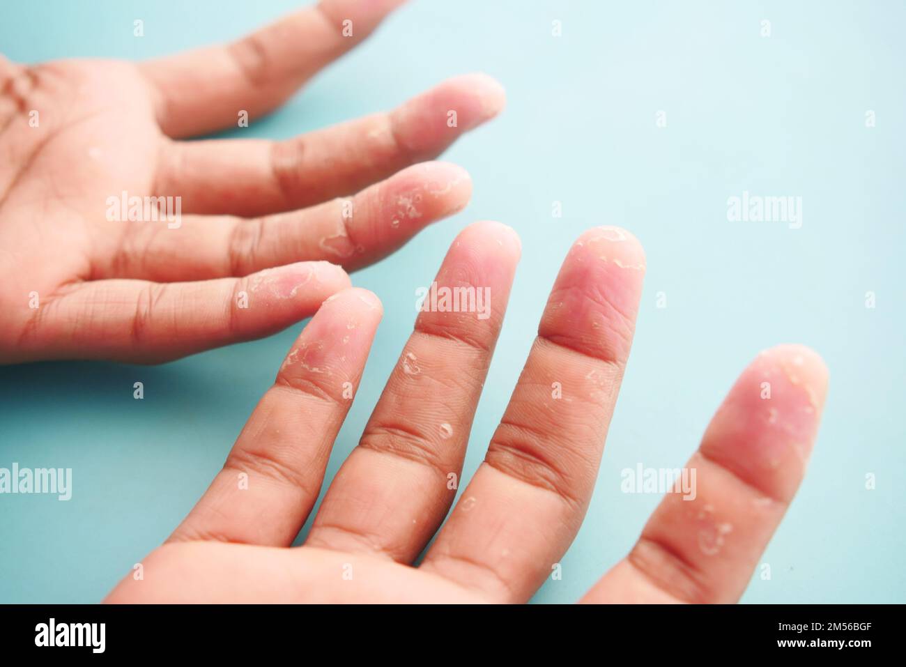 close up of Dry cracked skin of a men's hand  Stock Photo