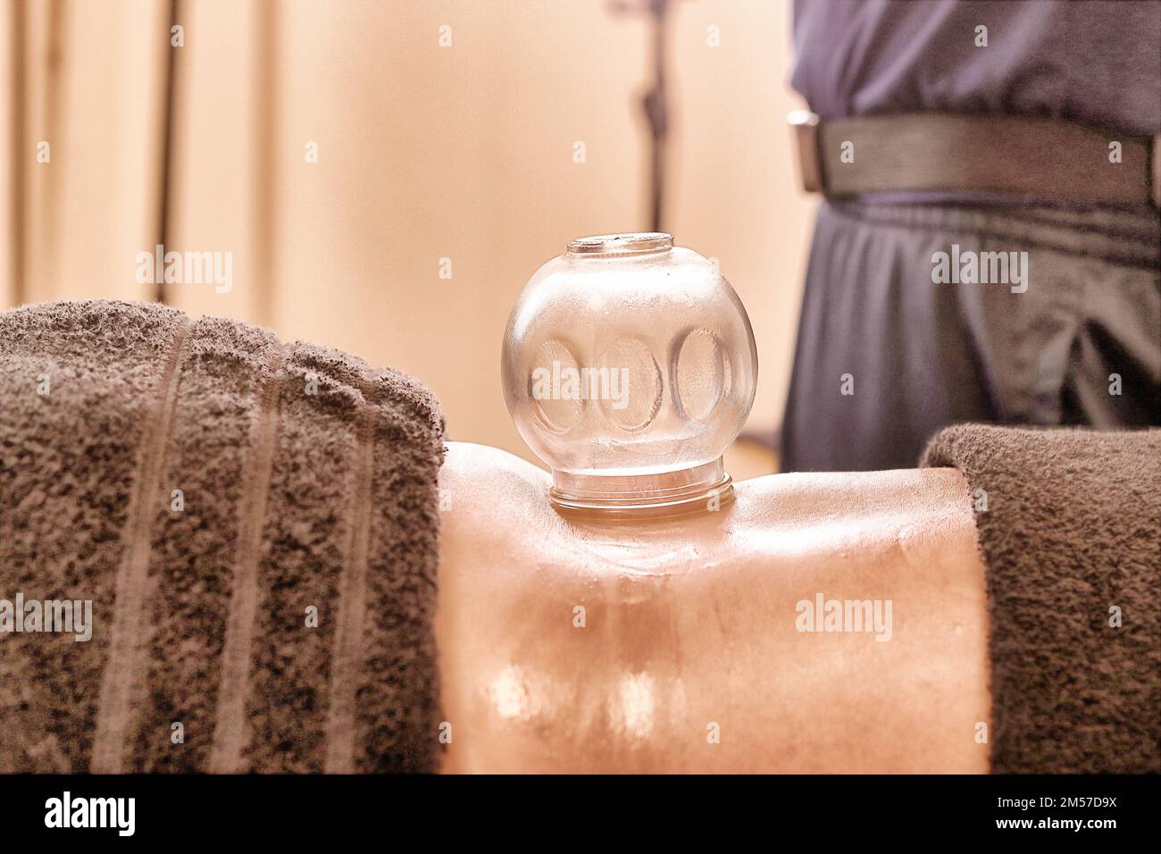 Professional, Male Massage Therapist Performing Cupping Vacuum Massage Treatment (Chinese Glass