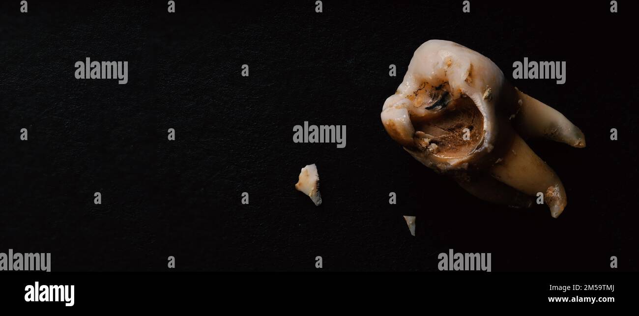 Tooth decay on black background. Macro shot of a decayed teeth till ...
