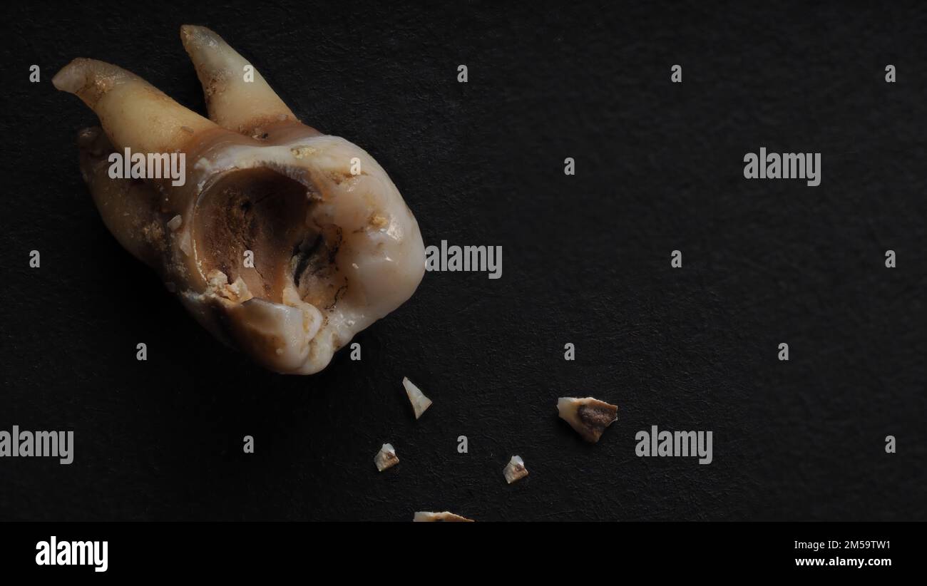 One Tooth Decayed Tooth decay on black background. Macro shot of a decayed teeth till ...