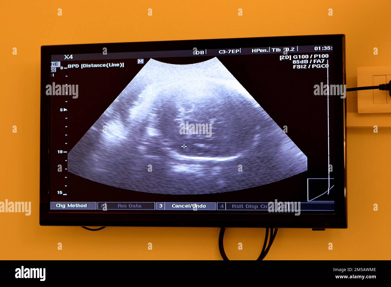 Ultrasonography on the uterus of a pregnant woman showing a healthy fetus, maternal ultrasound