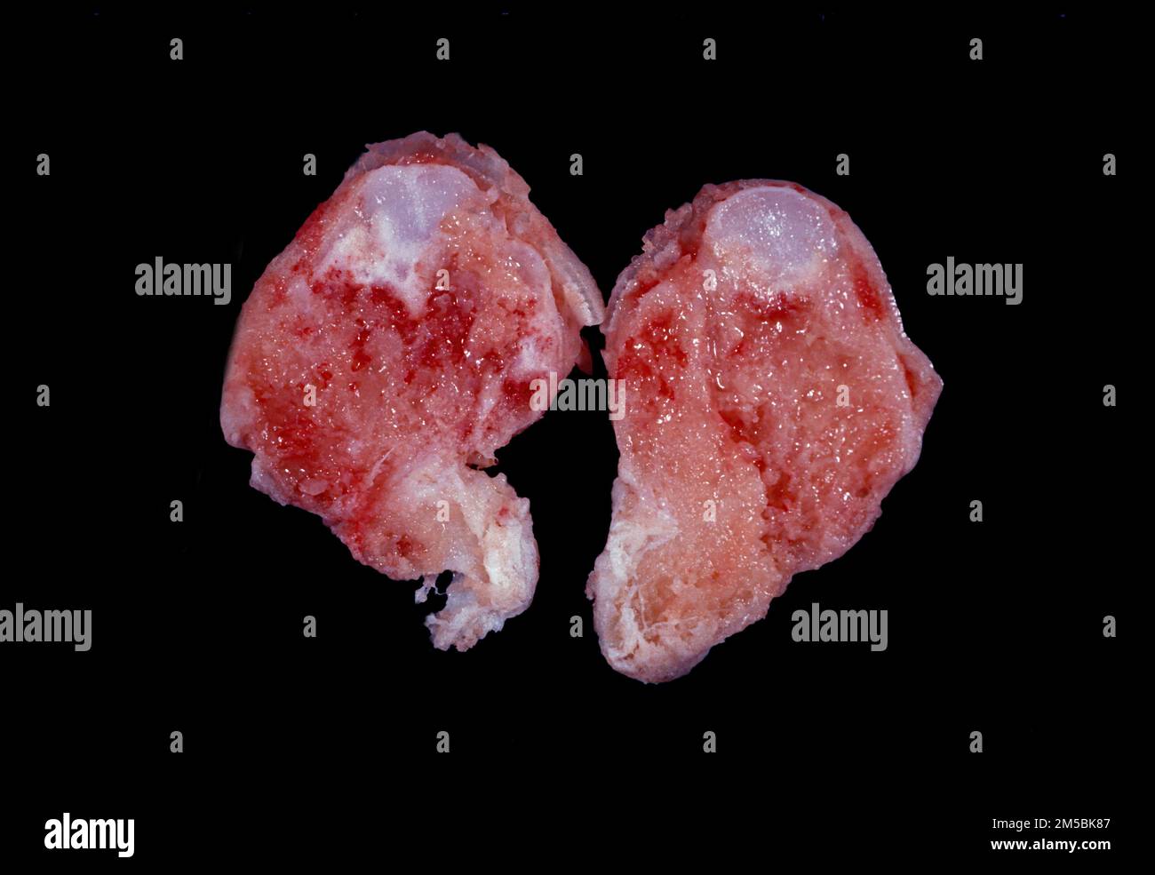Slice of human tibia showing an osteochondroma, the most common benign bone tumour appearing as a whitish nodule of cartilaginous tissue. Stock Photo