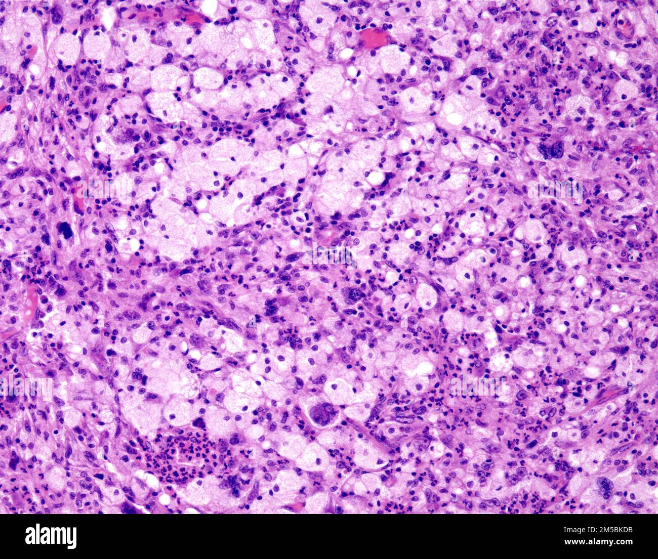 Undifferentiated pleomorphic sarcoma, light micrograph