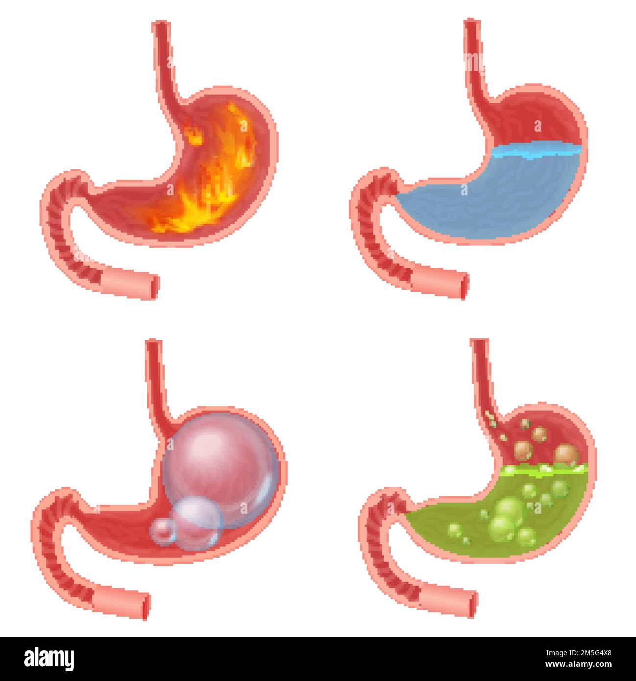 Vector Realistic Stomach medical vector illustration set. Pyrosis fire disorder, gastric acid reflux, Abdominal bloated ball, green liquid nausea Stock Vector