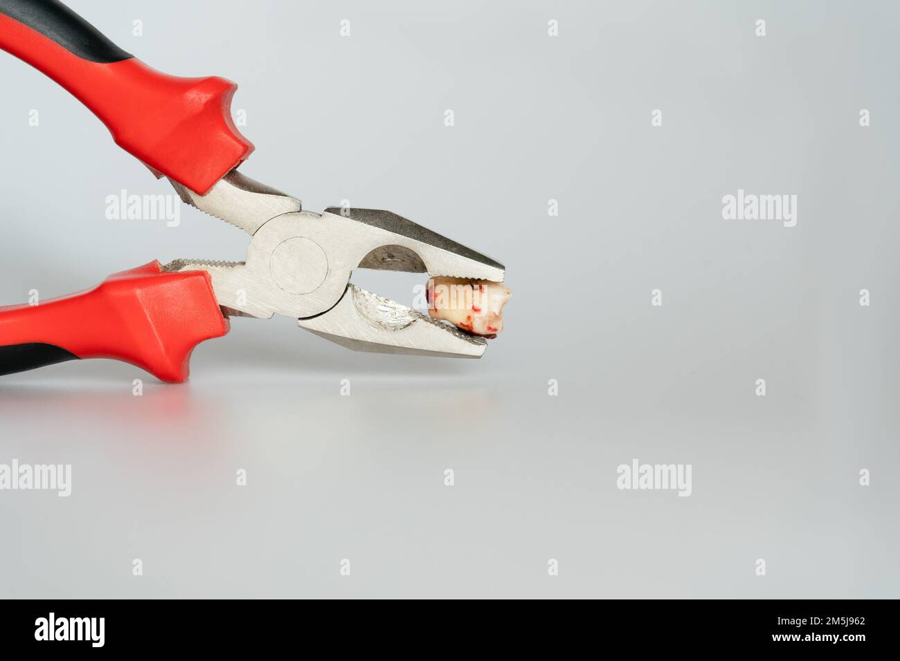 Tooth extraction with dental tools with caries by a professional