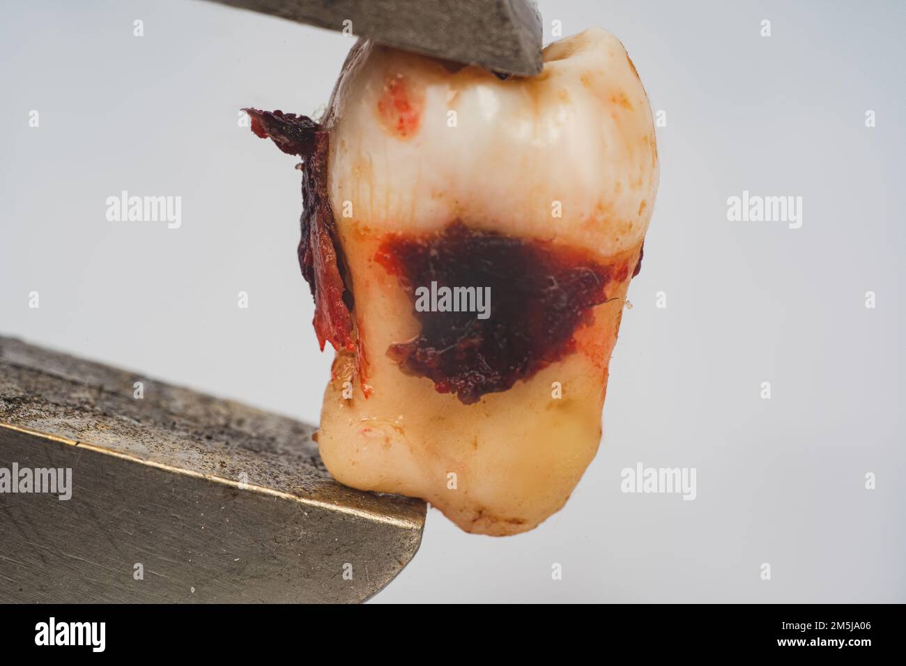 Human wisdom tooth inside a dental tool. Dentistry concept. Macro photo of a wisdom tooth close-up with a dental floss Stock Photo