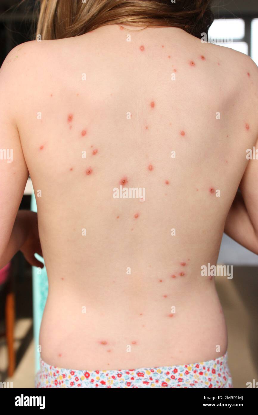 chickenpox spots and scabs on a childs back and tummy Stock Photo - Alamy