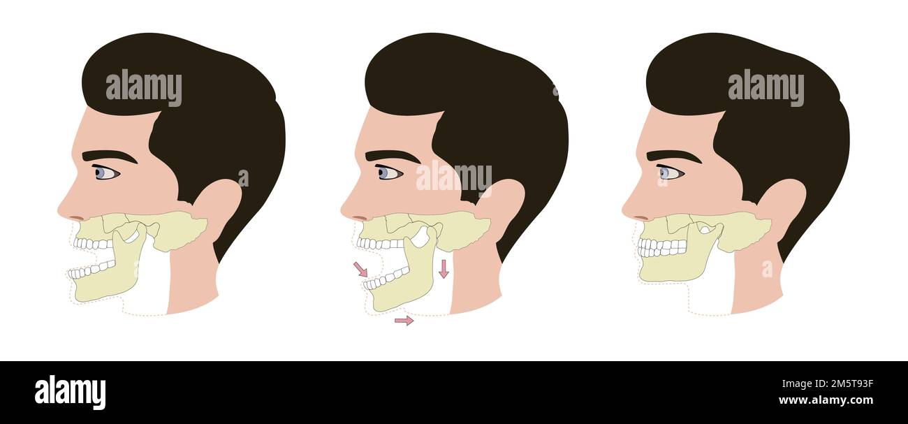 dislocated Jaw vector illustration first aid Stock Vector