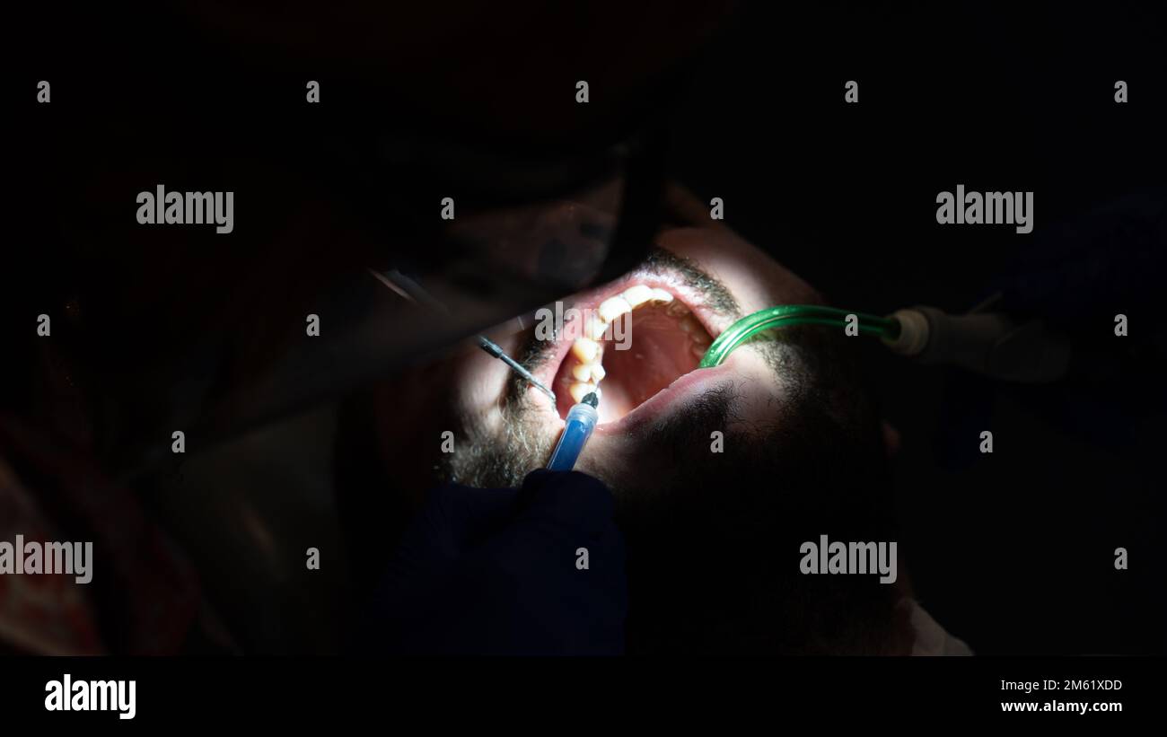 Tooth decay prevention. man in the dentist chair during a dental procedure. Smile makeover. Stock Photo