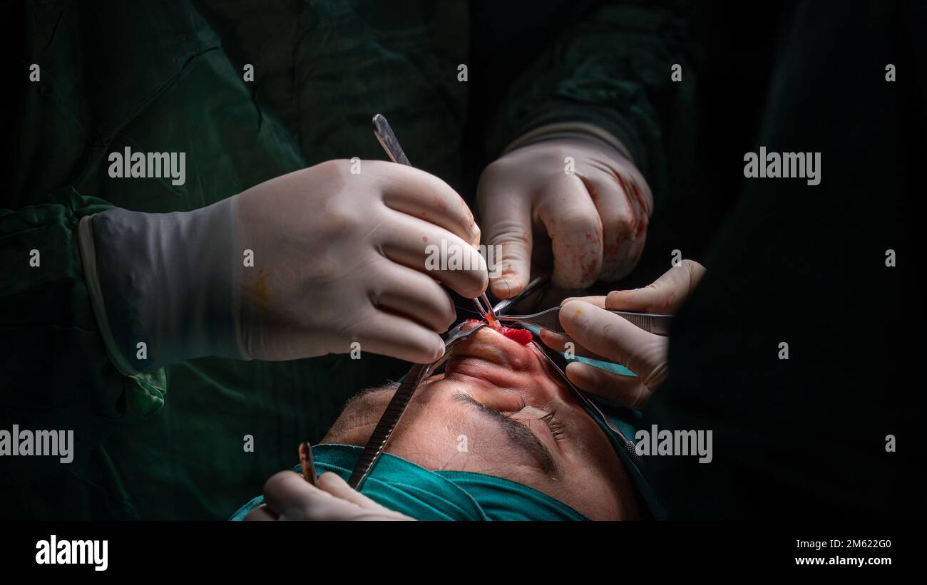rhinoplasty surgery, defects in the shape of the nose in the female patient. Surgical intervention in plastic surgery rhinoplasty Stock Photo