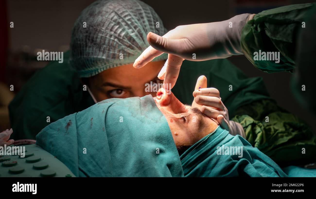 rhinoplasty surgery, defects in the shape of the nose in the female ...