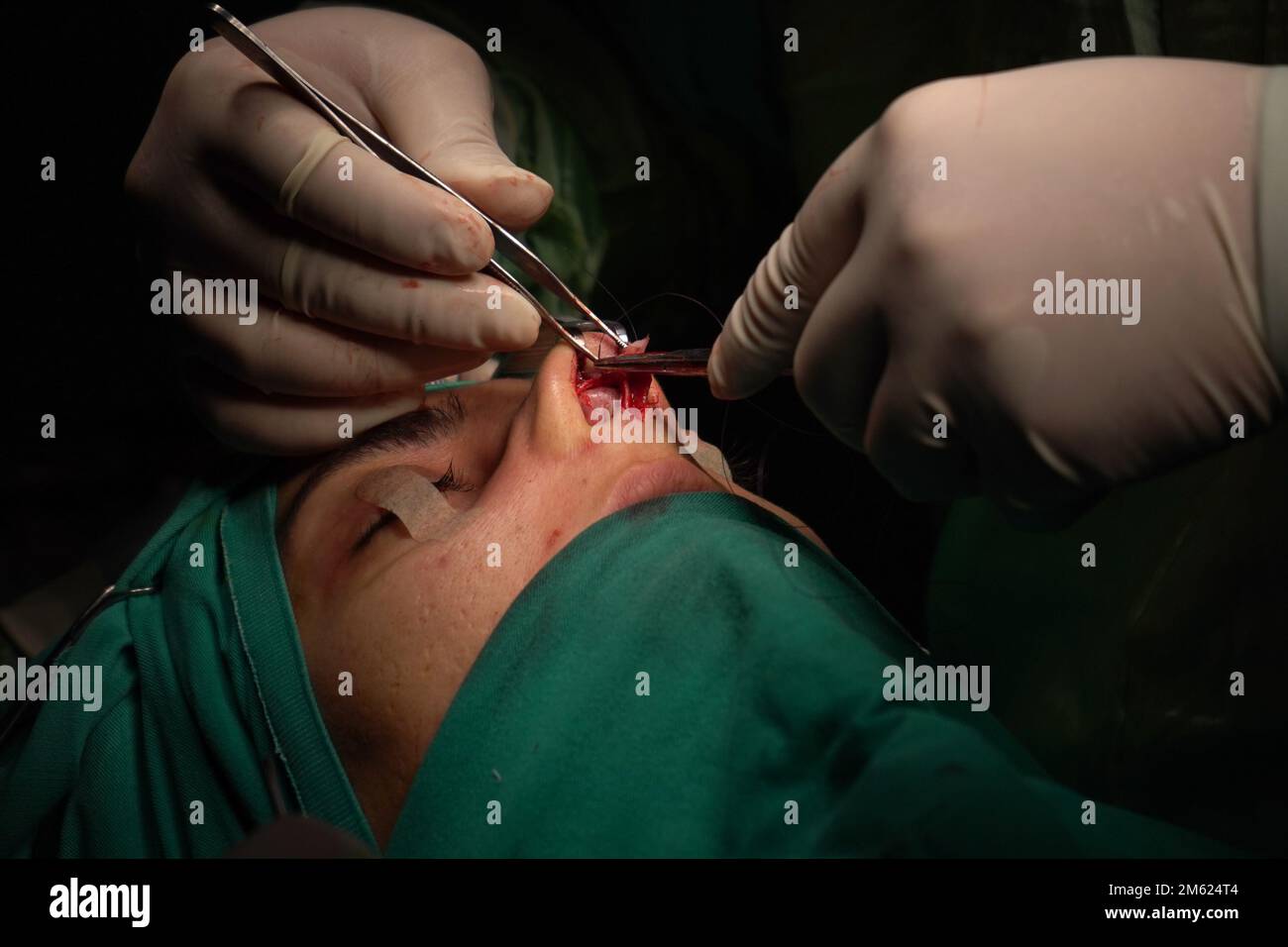 rhinoplasty surgery, defects in the shape of the nose in the female ...