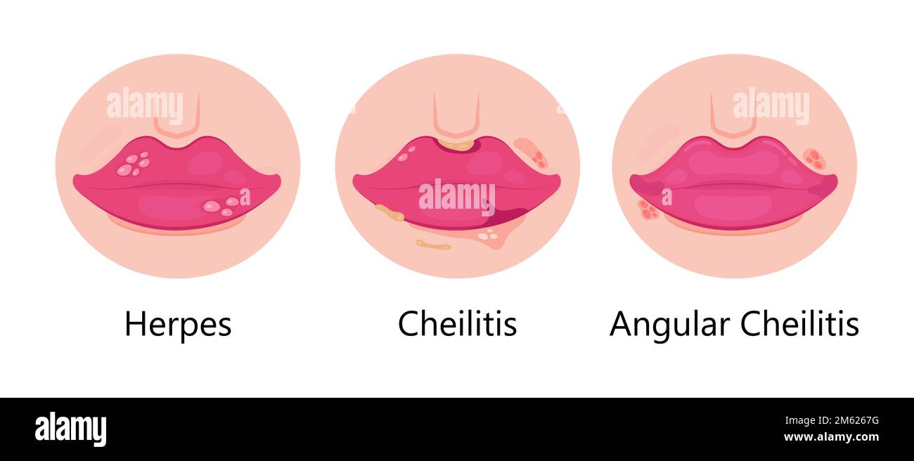 Herpes lips vector. Simplex virus infection causes recurring episodes