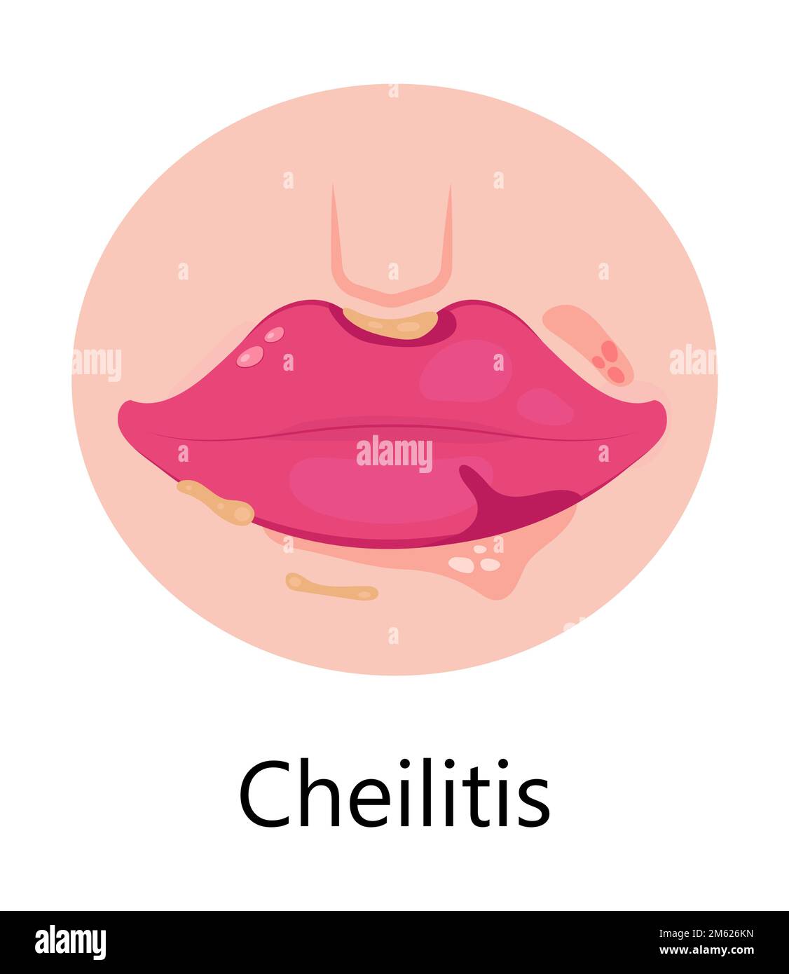 Herpes lips vector. Simplex virus infection causes recurring episodes