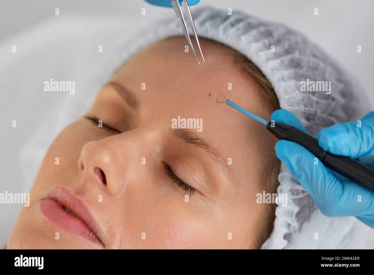 Removal of birthmark from client forehead closeup shot Stock Photo