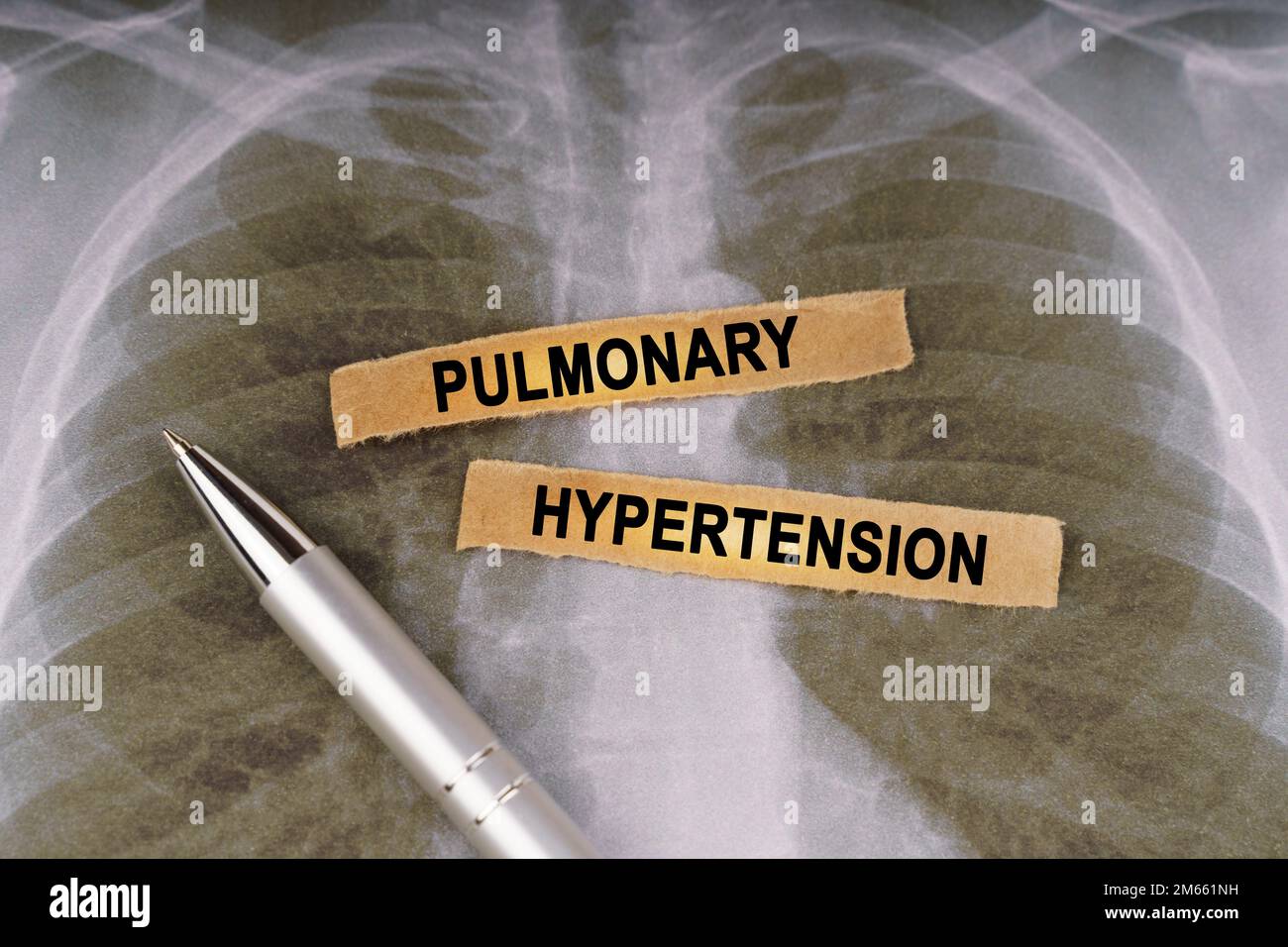 Medical concept. On a human chest xray, a pen and strips of paper
