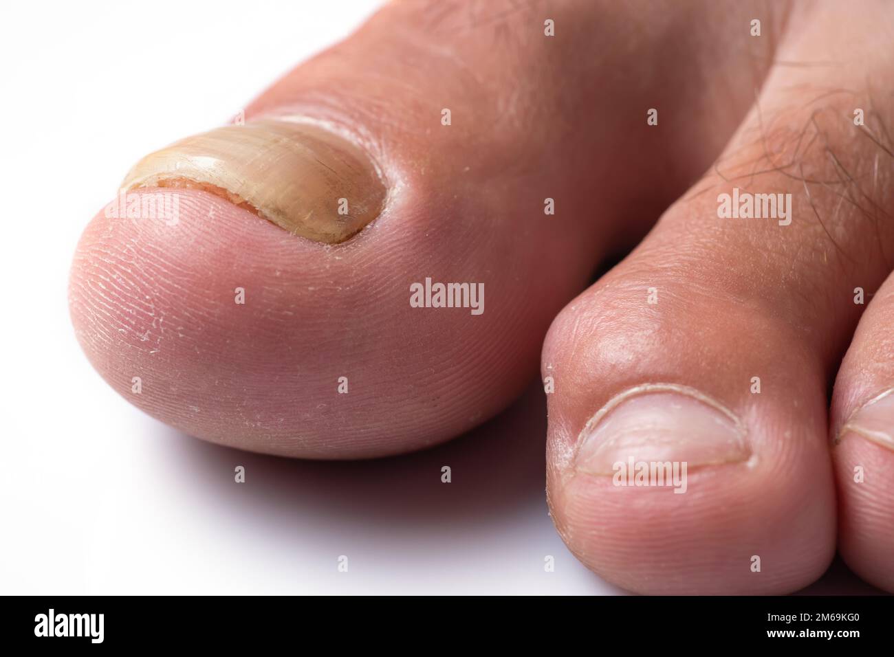 Toe nail with psoriasis and healthy toe nails, Psoriatic nail, close-up Stock Photo