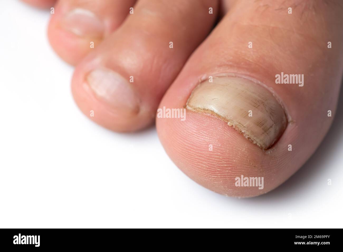 PDF) Non-Dermatophyte Moulds as Pathogens of Onychomycosis