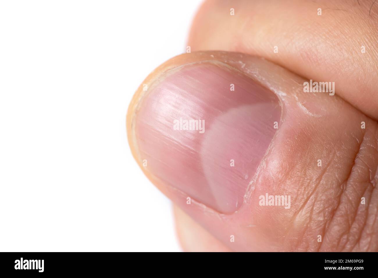 Abnormal fingernail hi-res stock photography and images - Alamy Abnormal fingernail hi-res stock photography and images - Alamy