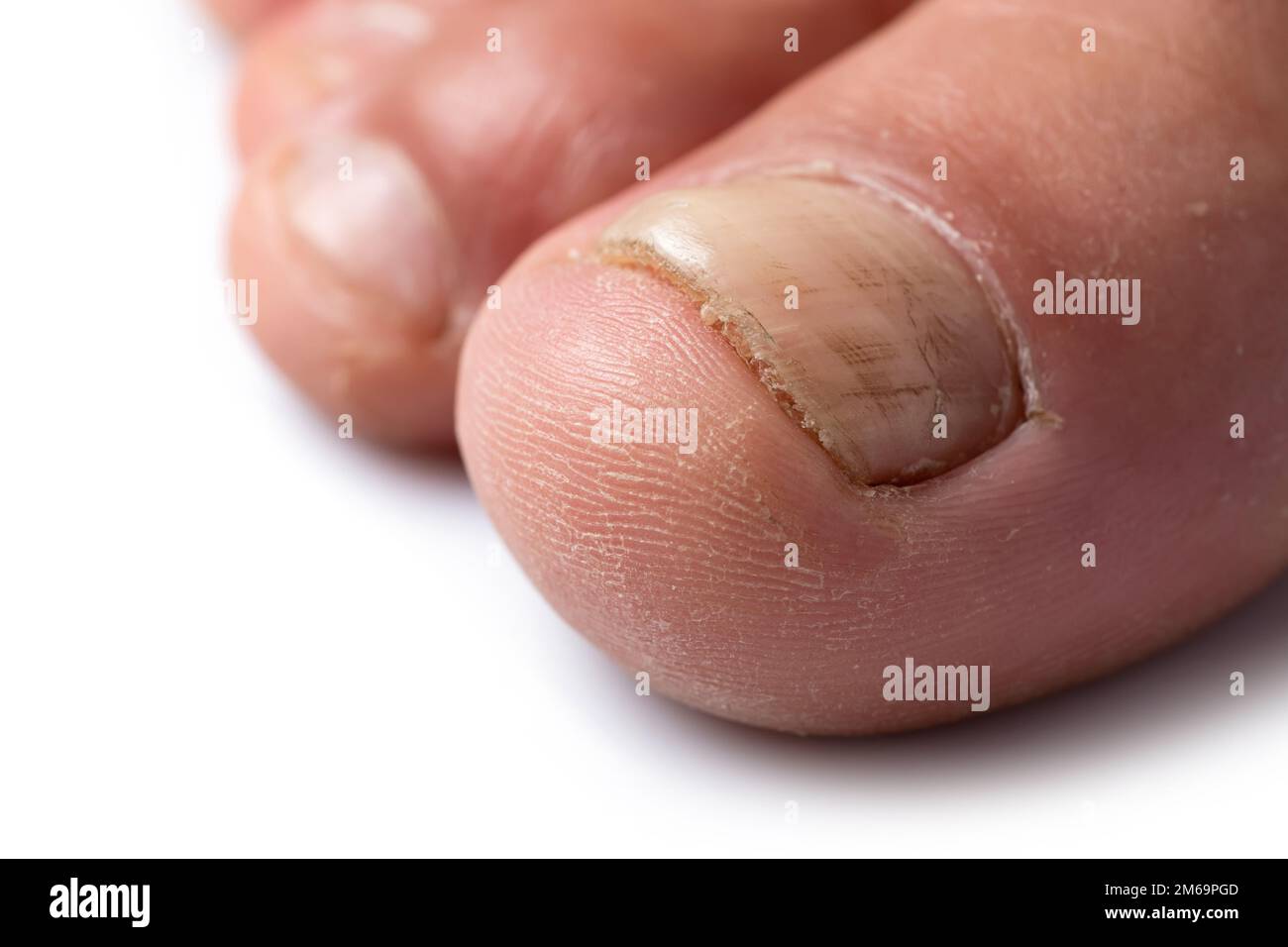 Close up image of a finger with nail fungus infection, Stock Photo
