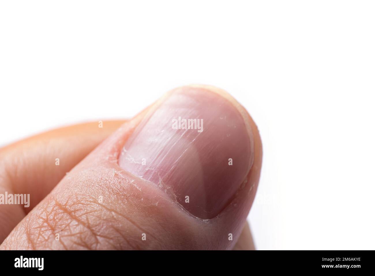 Ridges in Fingernails: Causes, Symptoms, Treatment, Prevention