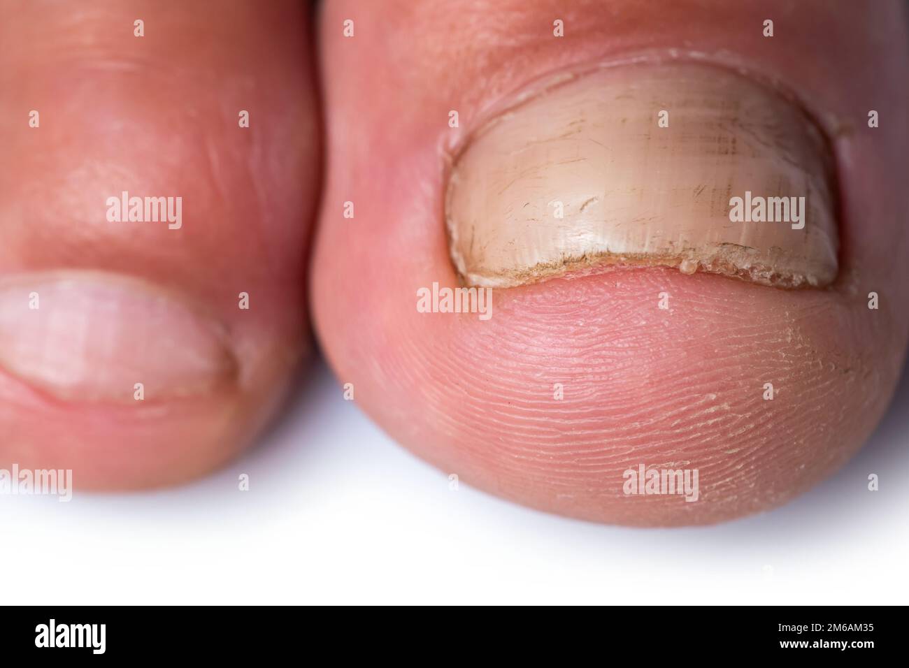 Close up image of a finger with nail fungus infection, Stock Photo
