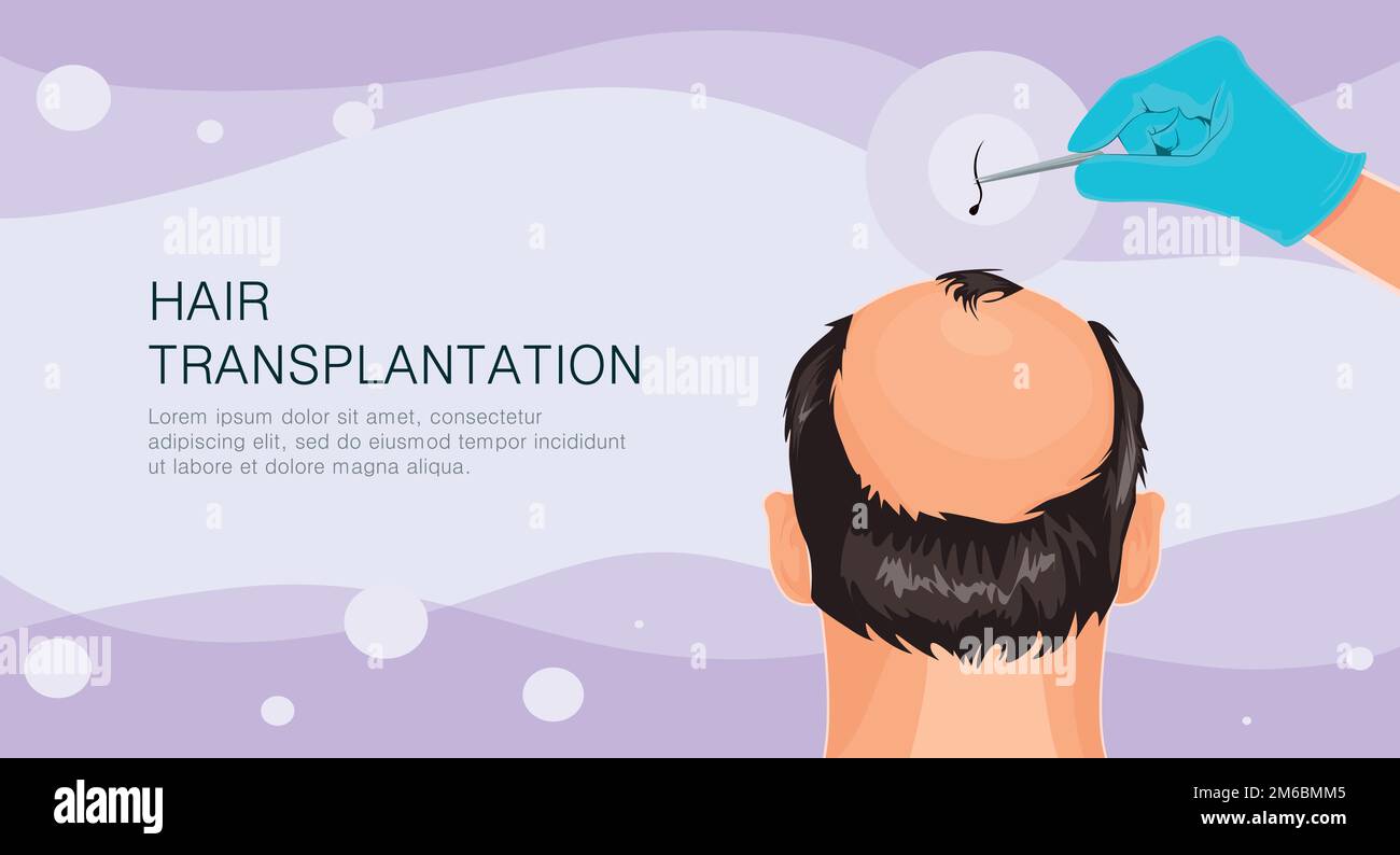 Hair loss. Stages of alopecia man problem vector medical health illustration Hair transplant illustration Stock Vector