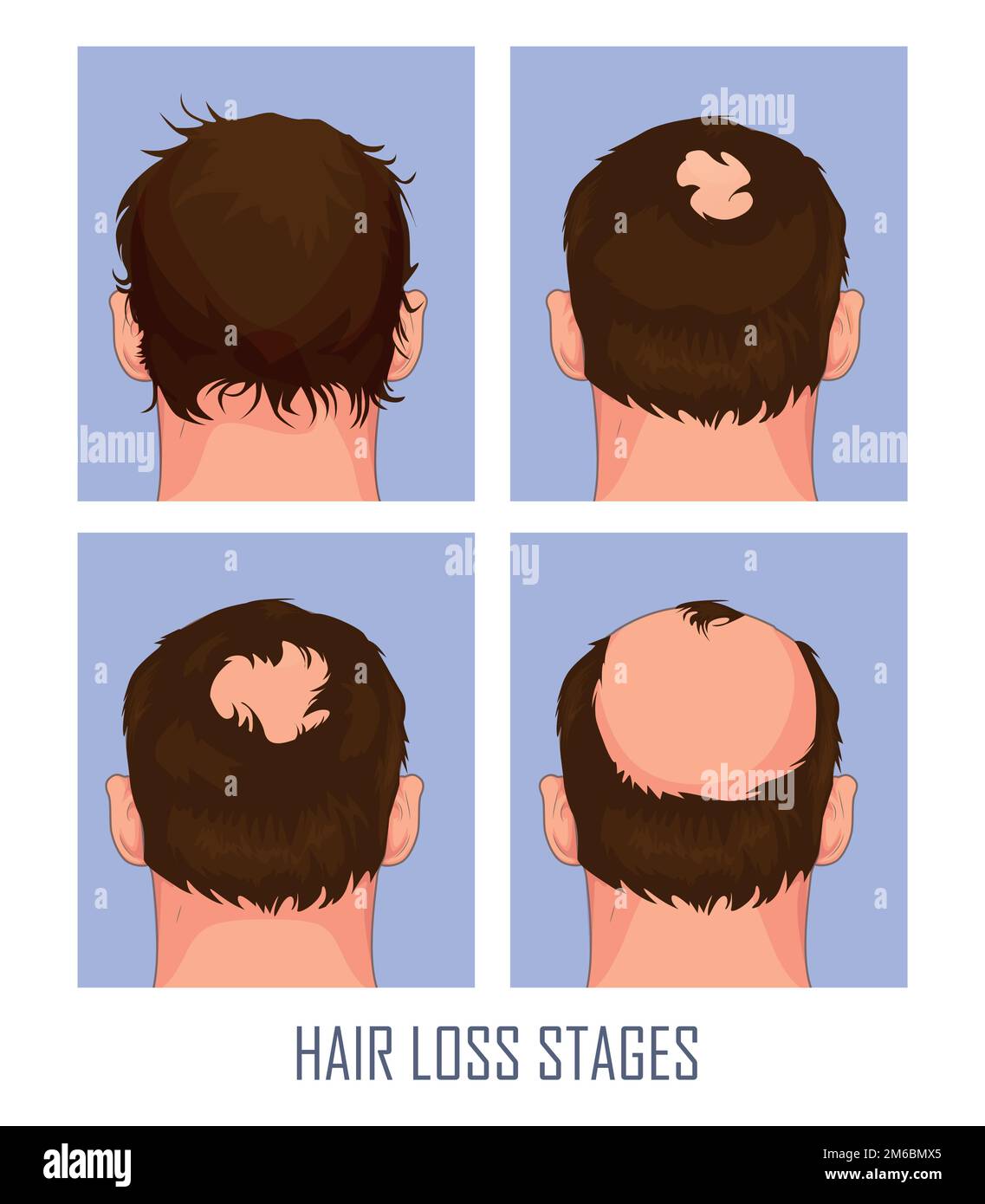 Hair loss. Stages of alopecia man problem vector medical health illustration Stock Vector